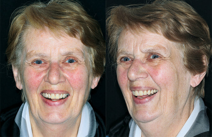 Figs: 15 and 16. The patient with her dentures. New quality of life and stability