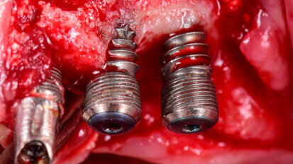 Systematic overview improves understanding of periimplantitis