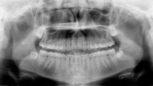 Optimal timing for management of impacted canines