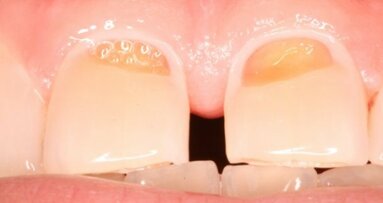 Erozyjne ścieranie zębów – raport EFCD