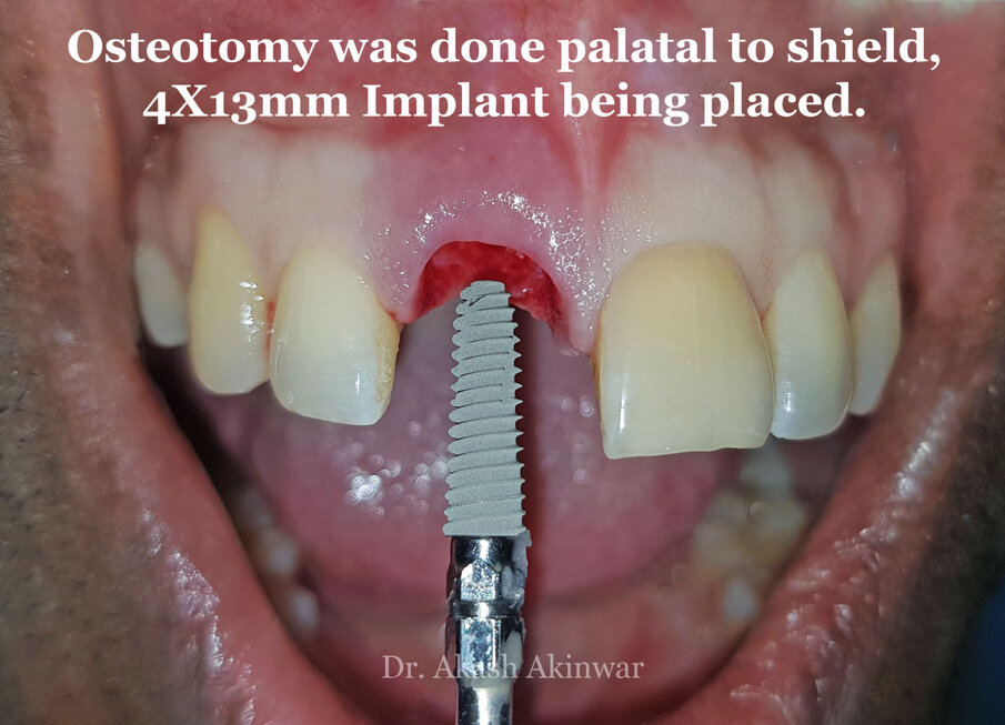 Fig 15: Osteotomy done on the palatal wall to receive a  4 x13 mm implant