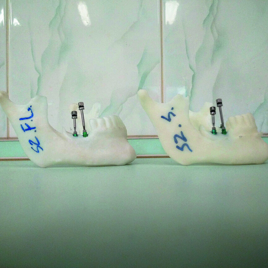 Fig. 6: Models after performing the procedures with the use of the guide. The same  of the implants inserted are visible.