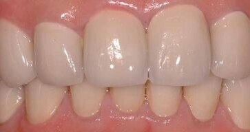 Management of full mouth prosthodontic rehabilitation using high-strength CAD/CAM zirconium-oxide crowns