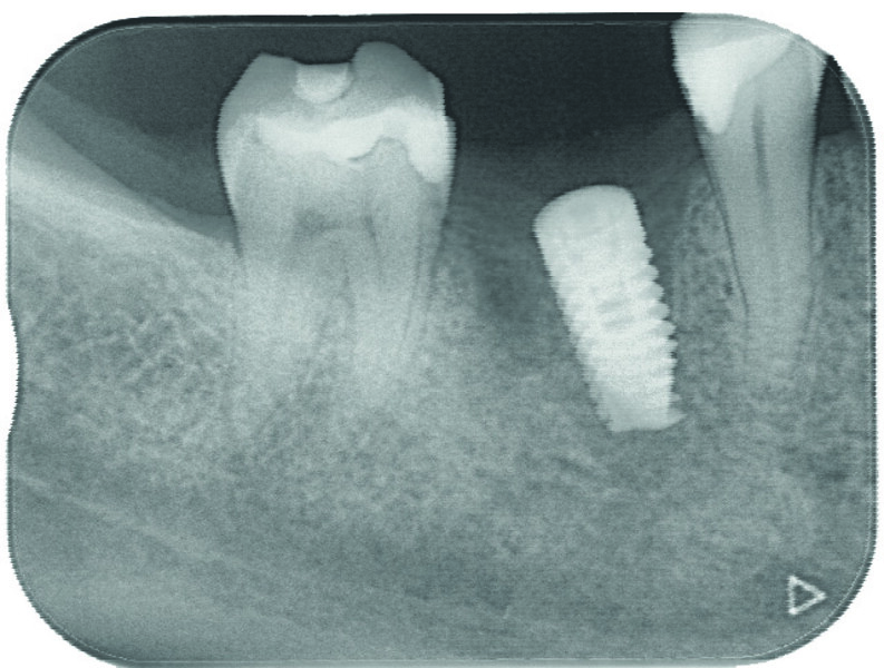 Fig. 12 : Radiographie de contrôle postopératoire de l’implant en 46. 