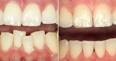 Gerade Zähne in Rekordzeit: Zahnarzt erklärt innovative Behandlungsmethode