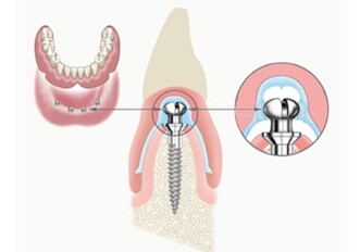Mini implants stabilize, cushion dentures — no adhesive needed