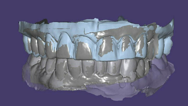 Digital face-bow transfer technique dentofacial analyser for dental aesthetics