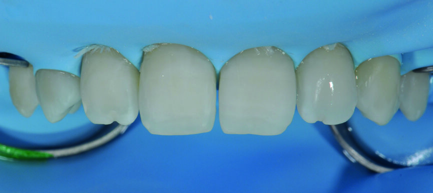 Fig 5b) : Les surfaces dentaires ont été légèrement sablées pour obtenir une performance adhésive optimale.