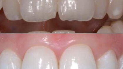 Inman Aligner: Korigovanje položaja zuba, beljenje i izrada direktnih adhezivnih restauracija – progresivni pristup preoblikovanju izgleda osmeha (Drugi deo)