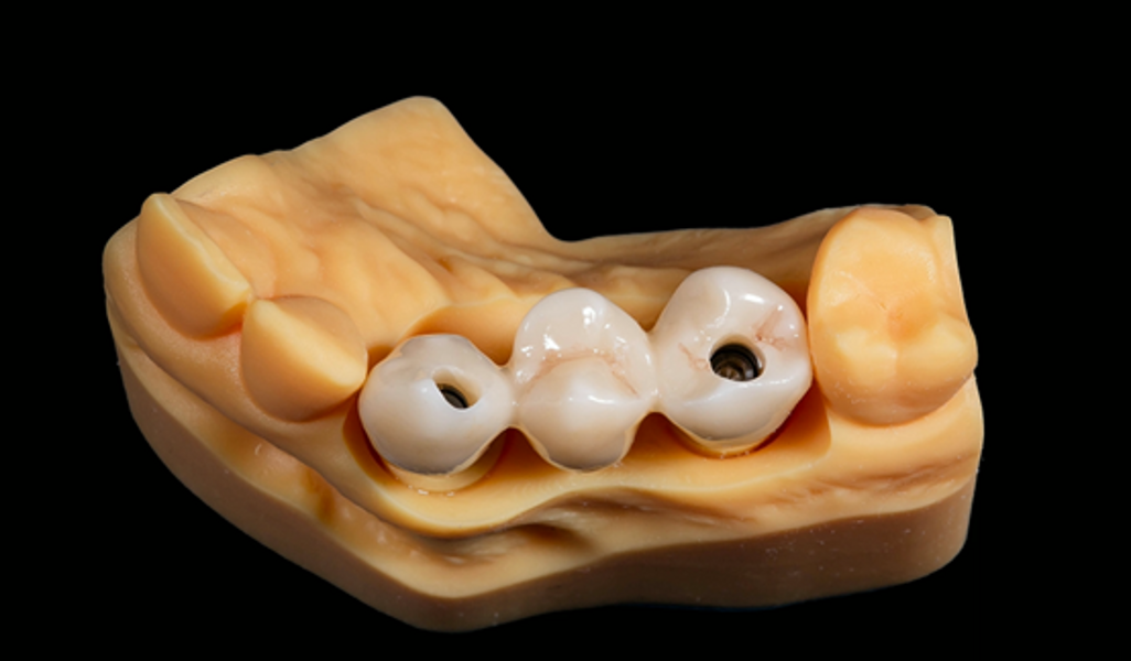 Fig. 12: Final restoration on the model, occlusal view.