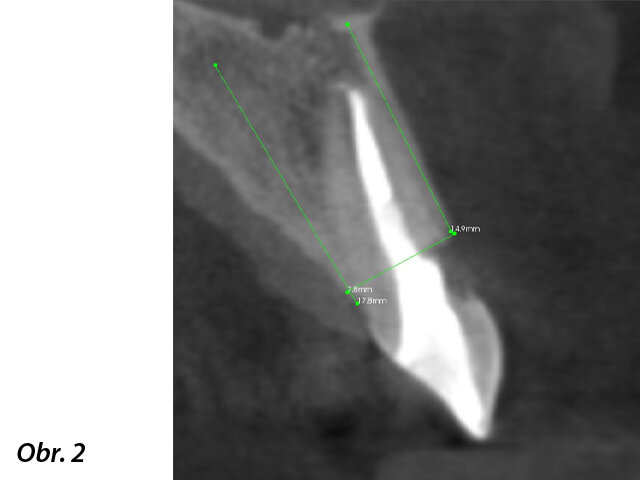 CBCT snímek, na kterém je vidět fraktura kořene zubu i vnější resorpce kořene z vestibulární strany.