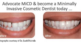 Prihvatite trend (MiCD Minimalno invazivna estetska stomatologija)