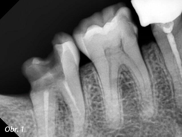 Preoperační rentgenový snímek zubu 46. Obr. 2: Meziálně excentrický rentgenový snímek s pěti viditelnými kořenovými kanálky.