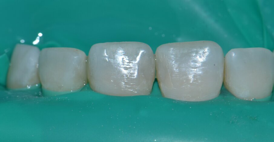 Fig 8: Incisal edges built up and caries treated with Stress-Reduced Direct Composite