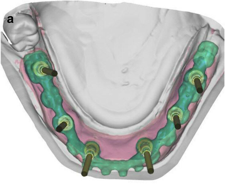 Fig. 6a: Occlusal view showing CAD of the provisional FDP framework (a) and close-up views from the interface between the CAD framework and the prefabricated titanium abutments (b & c).