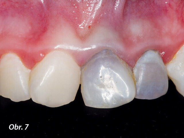Obr. 7: Zbarvení korunek zubů po revaskularizaci