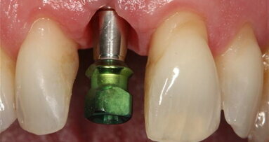 Stem cells may improve the adaptability of dental implants