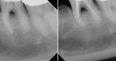 Absurdita v endodoncii