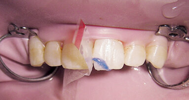 Léčba traumat zubů – doporučené postupy