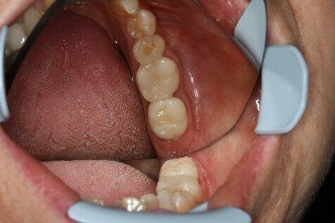 Final situation for tooth 37