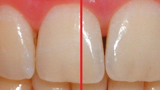 Valutazione clinica dell’azione sbiancante  di un dentifricio a base di biossido di titanio  con attivazione a luce led