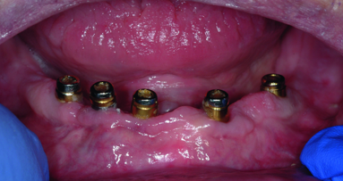 Treatment options for the edentulous arch