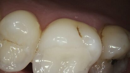 Removal of leaking amalgam restorations and placement of ceramic CAD/CAM inlays in one-hour