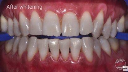 Teeth Bleaching: Get Better Results with GBT