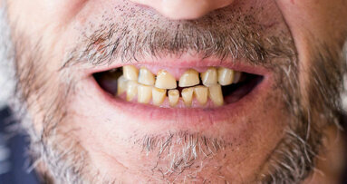 La pandémie entraîne une augmentation des problèmes de santé bucco-dentaire liés au stress