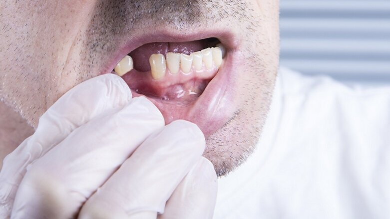 Загубата на зъби в средна възраст е свързана с повишен риск от коронарна болест на сърцето