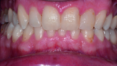 Approccio preventivo e cosmetico per lesioni smalto post trattamento ortodontico. Case report