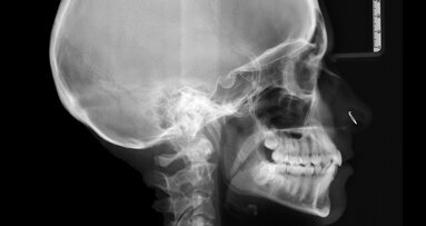 Ortodontická léčba komplexních případů malokluze pomocí průhledných alignerů