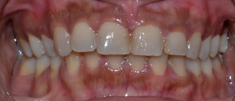 Fig 9: Before treatment photo showing initial signs of trauma from occlusion, incisal wear of upper anteriors, abfraction with 34 & 44. 