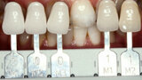 Fig. 2. Mediante la guía VITA Linearguide 3D-MASTER se determinó con precisión el color dental y se pudo seleccionar el correspondiente color de bloque 0M1.