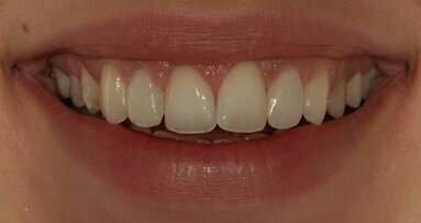 Conservative smile enhancement: Direct composite resin restoration of conoid lateral incisors
