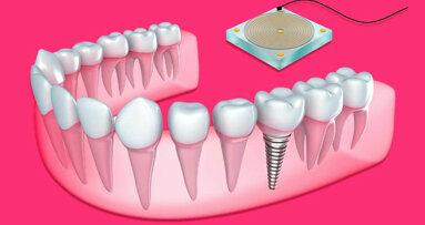New sensor monitors bone growth around dental implants