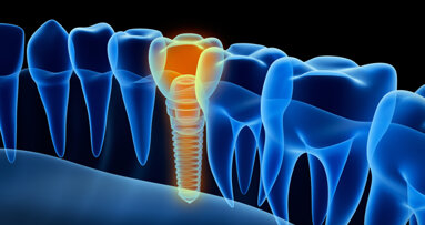 Ceramic implants: What benefits do they offer?
