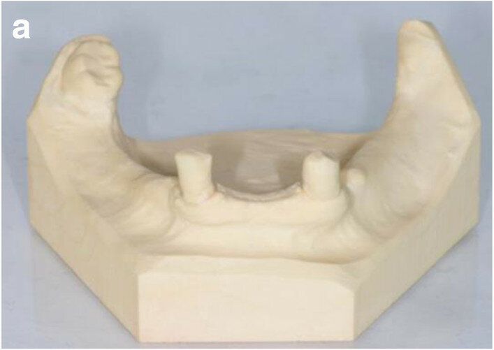 Fig. 3a: Frontal (a) and occlusal view (b) of the study models after extraction of teeth #41, 31 and 32.