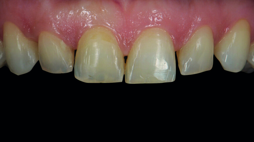 Fig. 2a: Anterior teeth after orthodontic treatment. 