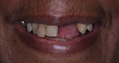 Tooth loss in Middle-aged is linked to increased coronary heart disease risk