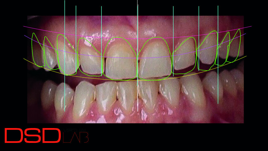 Fig. 3: Digital smile design indicating crown lengthening of teeth #13, 12, 11 and 21 and restorative treatment of the ten anterior teeth