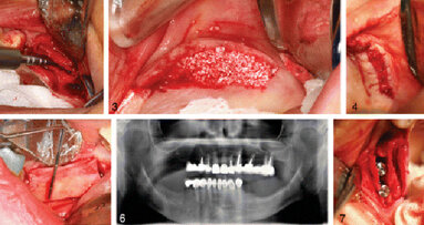 Established ridge-split procedure offers new application in implant surgery