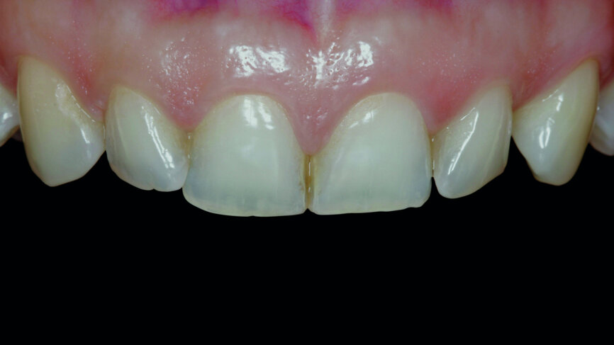 Fig. 1: Initial photograph of the anterior teeth prior to orthodontic treatment.