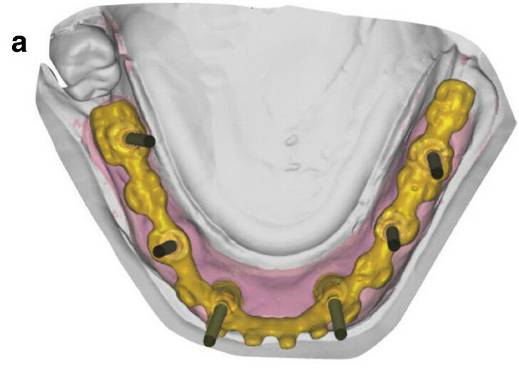 Fig. 12a: Occlusal view showing CAD of the final FDP (a) and detailed screenshot of the interface geometry (b).