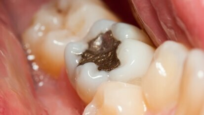EU-endorsed dental amalgam reduction enters into effect