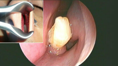 Supernumerary tooth grows in man’s nose