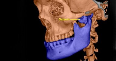 Des chirurgiens opèrent bouche ouverte, pour enlever une tumeur osseuse
