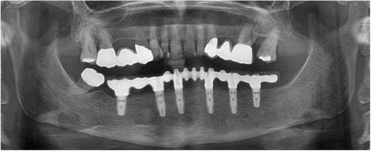 Fig. 15: Panoramic  radiograph at  delivery  of the  final  CAD/CAM FDP. 