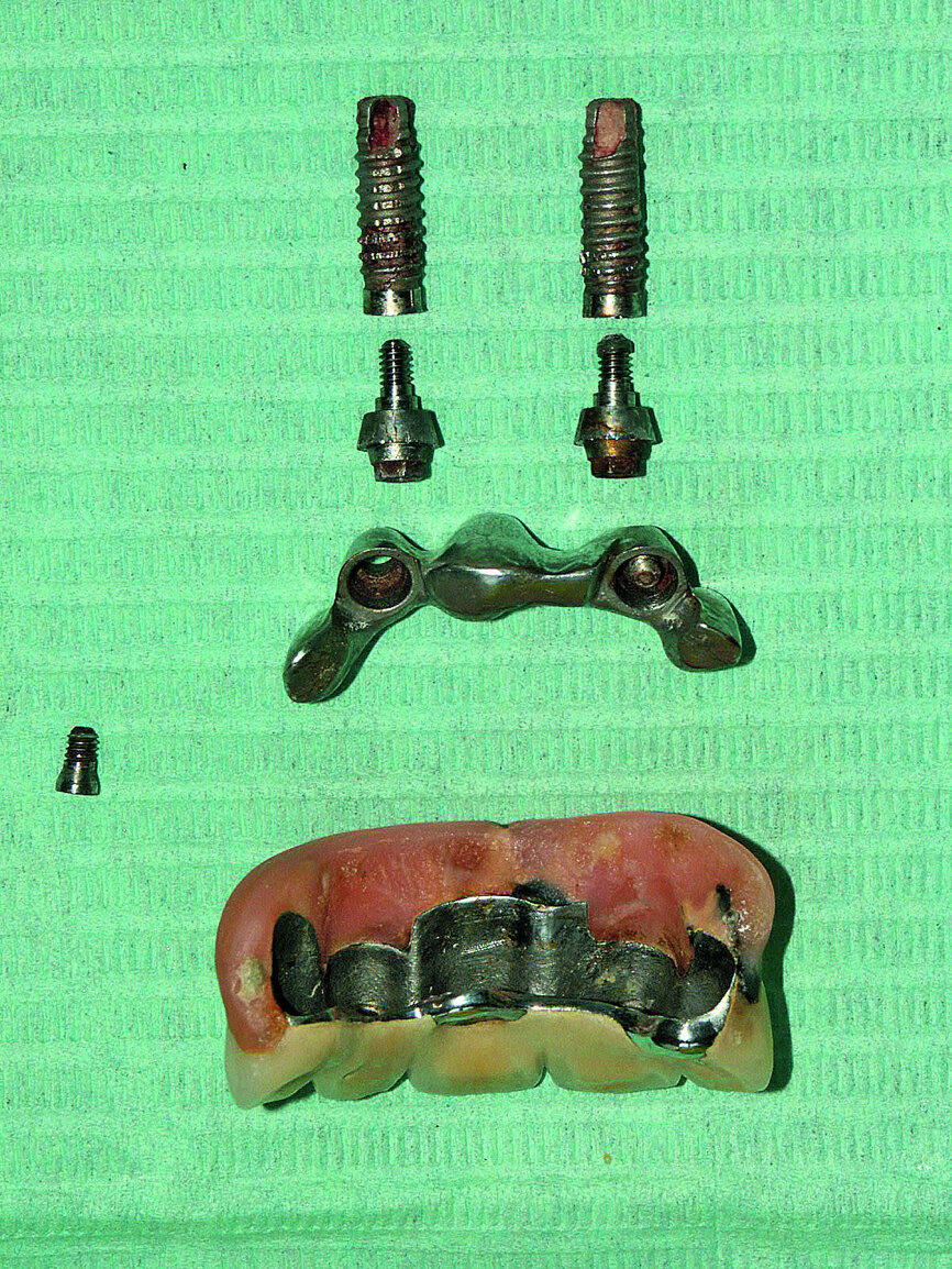 Fig. 4: The framework was unscrewed, abutments removed and implants easily removed.