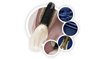 Simplicity without compromise with the Astra Tech Implant System EV from Dentsply Sirona Implants